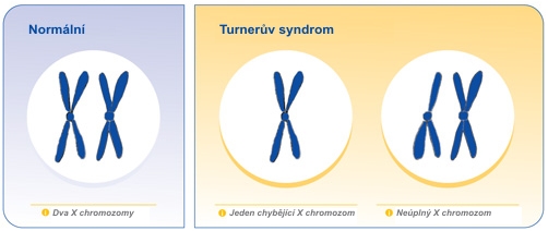 Turnerův syndrom